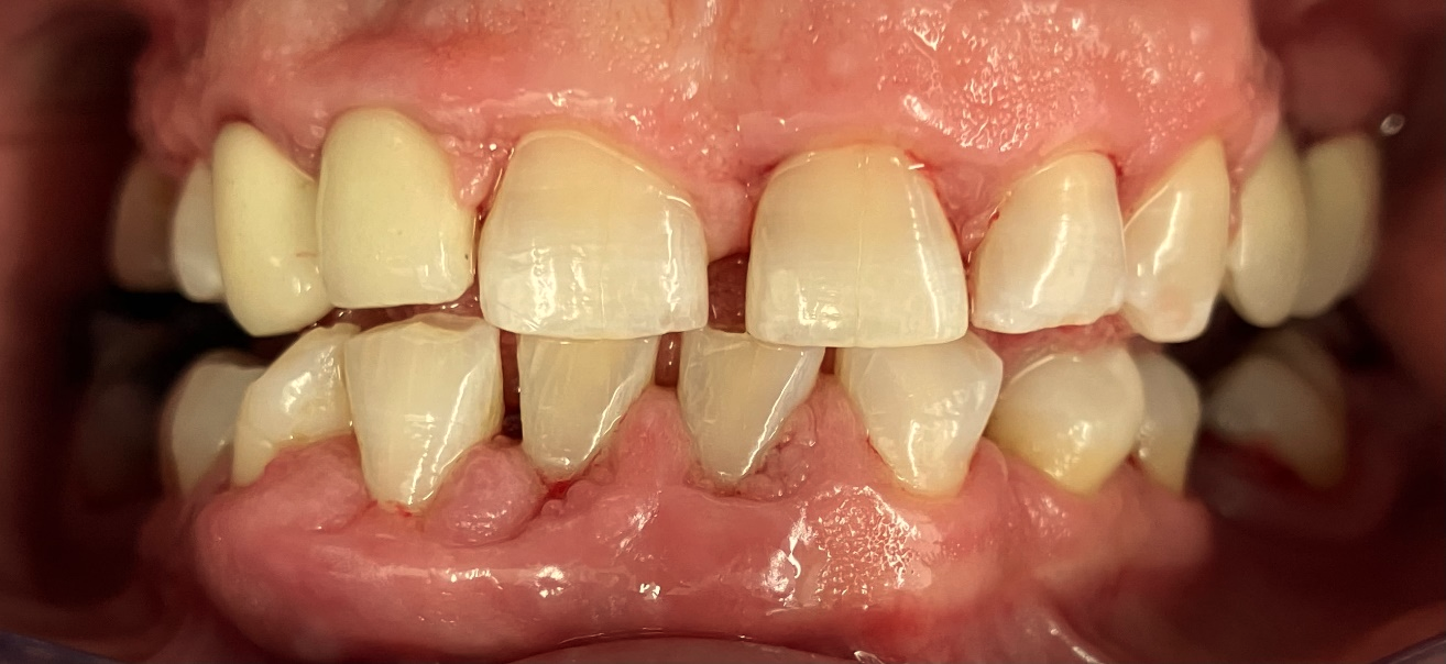 Signs and Symptoms of Periodontal Disease
