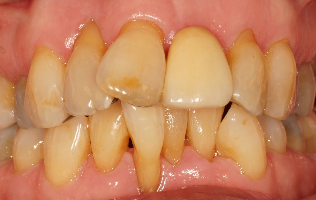 Clinical case – The difference good oral care can make to gum health