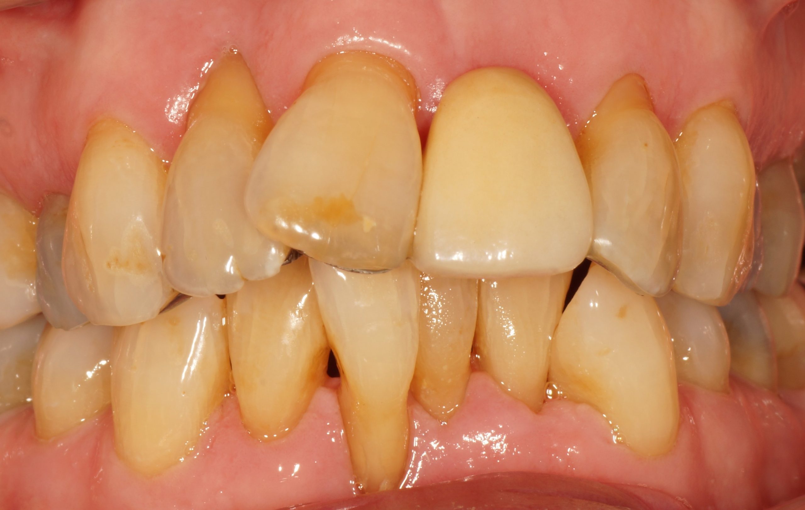 Clinical case – The difference good oral care can make to gum health