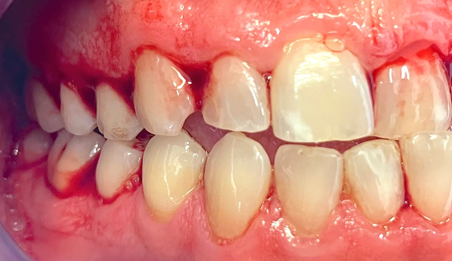 Does a lack of bleeding on probing mean a lack of periodontal inflammation?