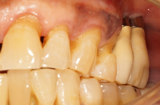 Achieving implant health in a challenging situation