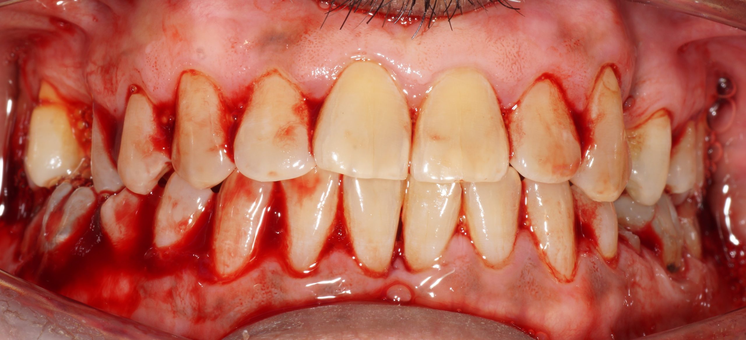 The real extent of periodontal inflammation